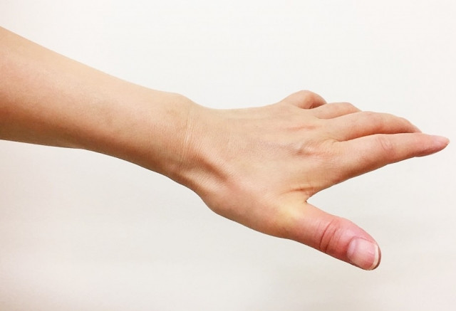 バネ指の施術で気をつけていることとは?